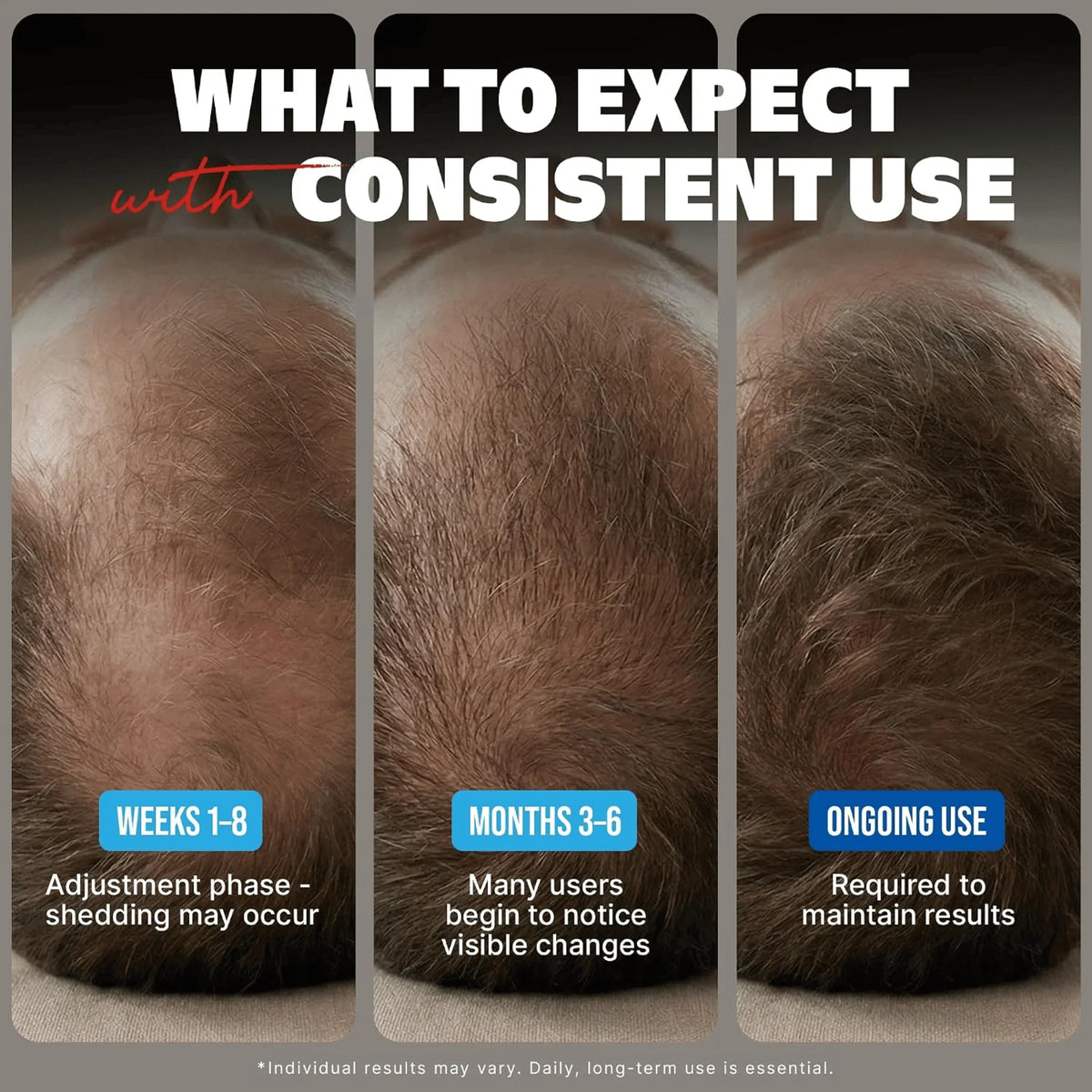 Kirkland Minoxidil 5% Hair Regrowth Solution for Men, 6-Month Supply